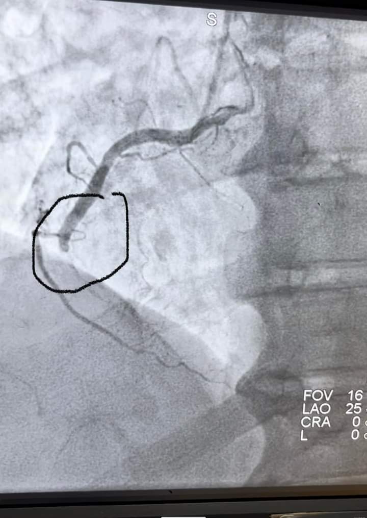 الذبحة الصدرية