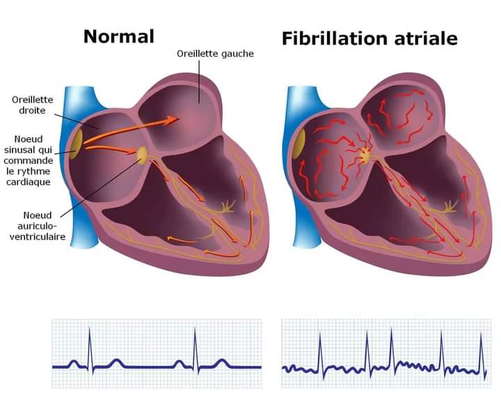 نوبات الرجفان الأذيني (القلب)