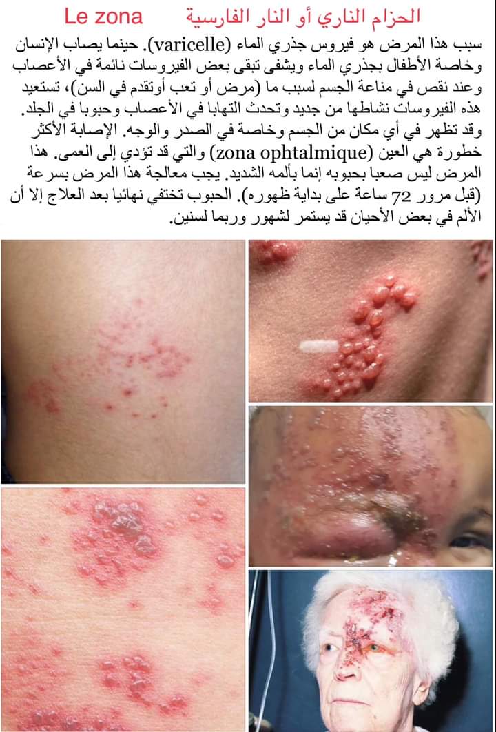 الحزام الناري أو النار الفارسية Le zona