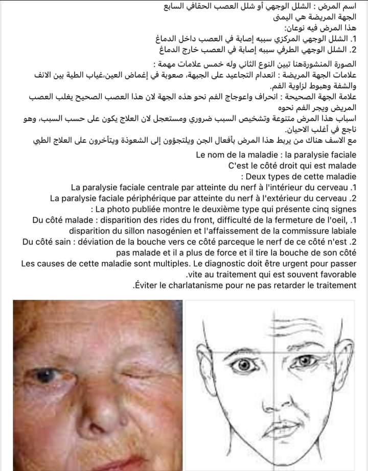 الشلل الوجهي   La paralysie faciale