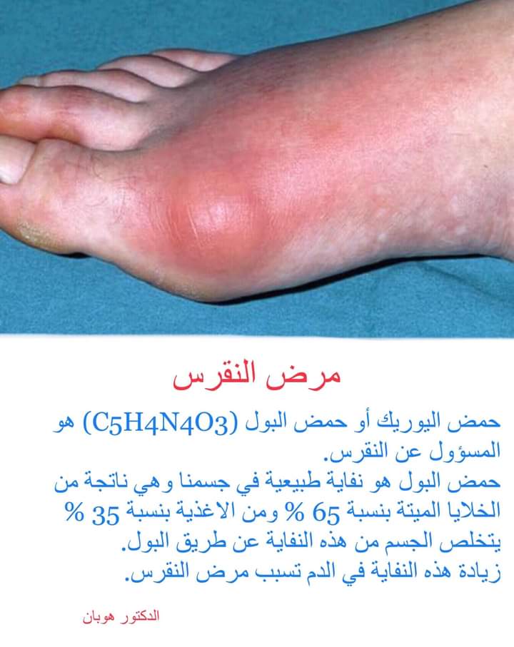 مرض النقرس
